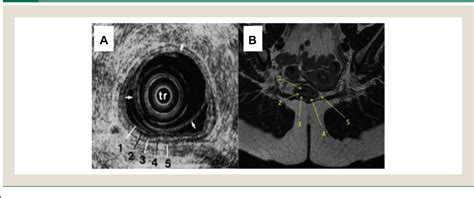 Figure From The Role Of Endorectal Ultrasound And Magnetic Resonance