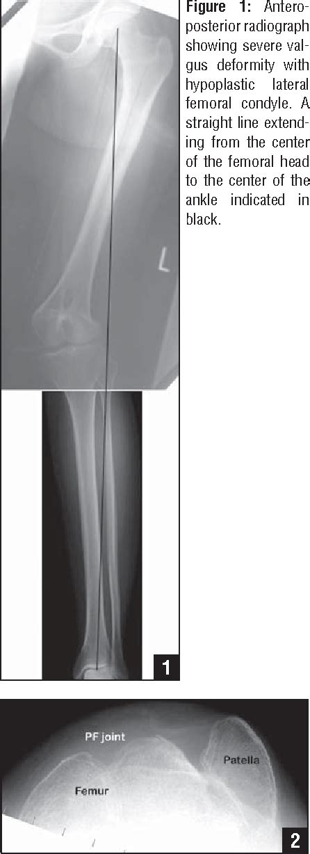 Figure 1 From Surgical Treatment For Permanent Dislocation Of The