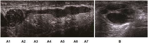 Efficacy And Safety Of Musculoskeletal Ultrasound Guided Aspiration And