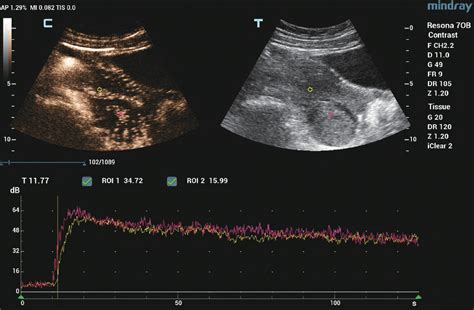 Figure 1 From Clinical Value Of Quantitative Analysis Of Contrast