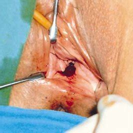 The Rectovaginal Fistula X Cm In Size And Cm Above The Anal Verge