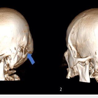 Preoperative three-dimensional reconstructed CT scan showing the left ...