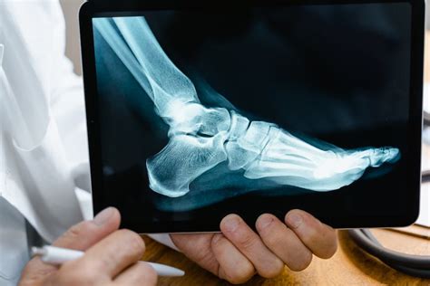 Wie Lange Dauert Eine Hallux Valgus Operation Erfahre Jetzt Was Du