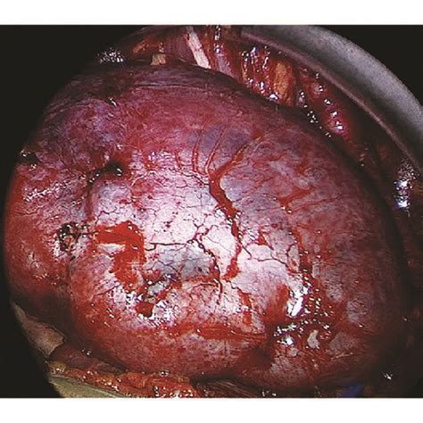 Intraoperative Fluorescence Imaging Using Indocyanine Green Icg