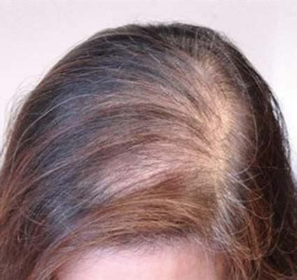 Womens Hair Loss Treatment Dr Health Clinic Homepage