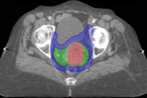 Post Radiation Therapy Imaging Appearances In Cervical Carcinoma