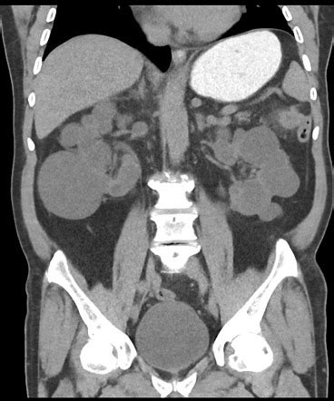 Tnm Staging Of Colorectal Cancer