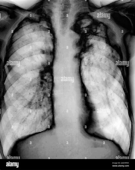 La Tuberculosis Radiografía De Tórax De Un Paciente Con Tuberculosis