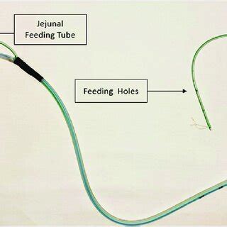 PDF Improvised Dual Lumen Nasojejunal Feeding Tube With Gastric