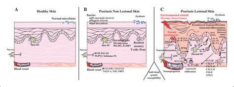 Jle European Journal Of Dermatology Psoriasis Is A Disease Of The Entire Skin Non Lesional