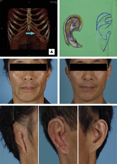 Aesthetic Auricular Reconstruction With Autologous Rib Cartilage Grafts