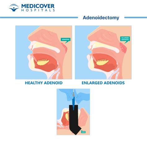 Get The Best Treatment For Adenoidectomy Adenoid Removal