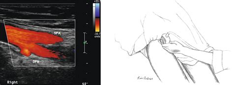 Lower Extremity Arterial Duplex Exam