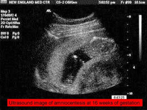 Alloimmune Hemolytic Disease Of The Fetus Newborn Rh Isoimmunization