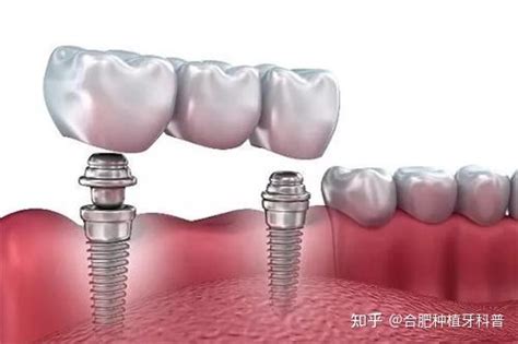 合肥种植牙一颗大约多少钱（集采后的种牙价格） 知乎