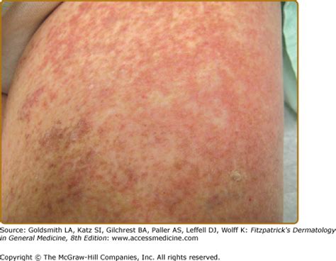 Mastocytosis Lesions