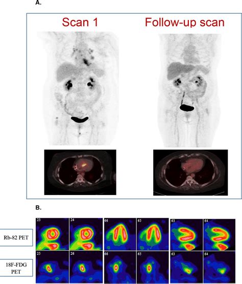 SciELO Brasil The Role Of 18 F FDG PET CT In Cardiac Sarcoidosis