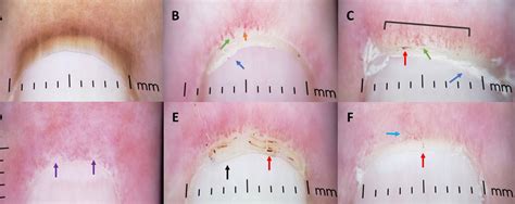 Characterizing Nailfold Capillary Changes In Dermatomyositis With A