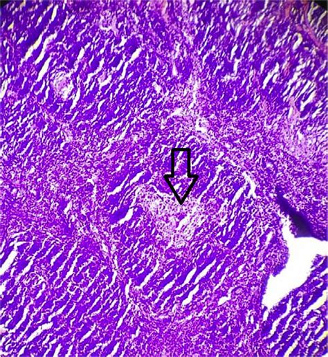 Hyaline Vascular Variant Of Castleman Disease Histopathology Shows