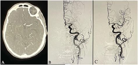 Frontiers Visualization Of Both Proximal M2 Mca Segments In Patients