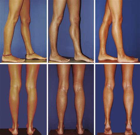 A slim 25-year-old woman with thin legs. (Left) Before the procedure ...