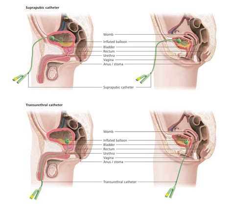 Indwelling Catheter