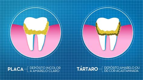 Tártaro e placa dentária Ideali Odonto Blog