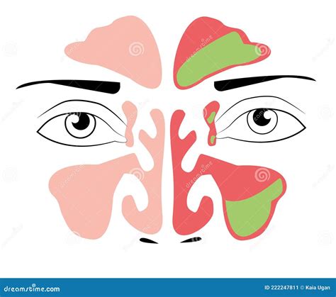 Sinusitis Medical Treatment Healthy And Inflammation Sinus Nasal