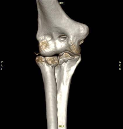 Radial Head Fracture Mason Type Ii Image Radiopaedia Org