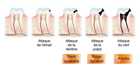 N Vralgie Dentaire Origine Sympt Mes Et Traitement