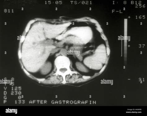 A CT Scan Through The Abdomen Showing A Duodenojejunal Mass With Normal