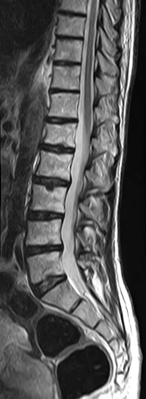 Ankylosing Spondylitis Andersson Lesions Image