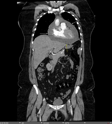 Large Hemorrhagic Pericardial Effusion And Cardiac Tamponade Following