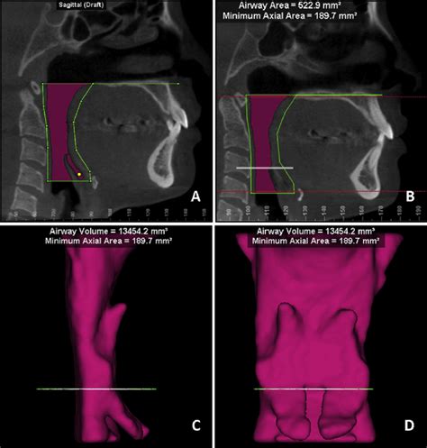 A Limits Determined To Assess Airway Volume B Calculations Of