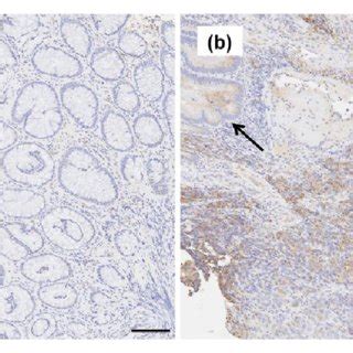 A No Fhl Immunohistochemical Expression Observed In Normal Colonic