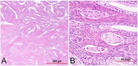 Pathology Of Cervical Carcinoma Glowm