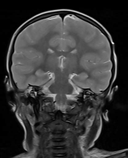 Diffuse Cerebral Edema Image