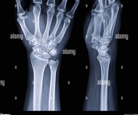 Comprendre votre radiographie du poignet à quoi ressemble une image