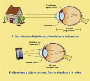 ¿Cómo detener la miopía progresiva? – Centro del Ojo Dr. Dueñas