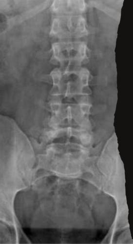 7 20 Intro To Lumbar Radiographs Flashcards Quizlet