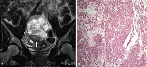 √ Uterus Endometriosis Ct Scan / Tumors Of The Uterine Corpus Clinical ...