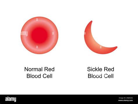 Normal Blood Cell Anemia Hi Res Stock Photography And Images Alamy