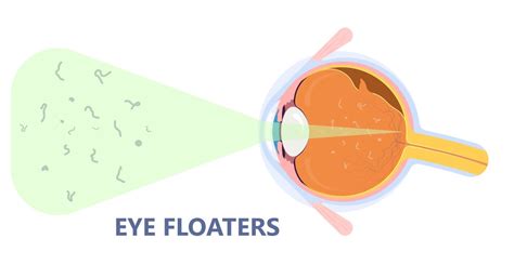 Floaters And Posterior Vitreous Detachment Optometrist In Sandpoint