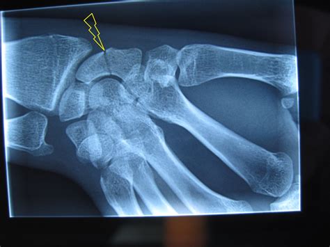 Fracture du scaphoïde Clinique du sport