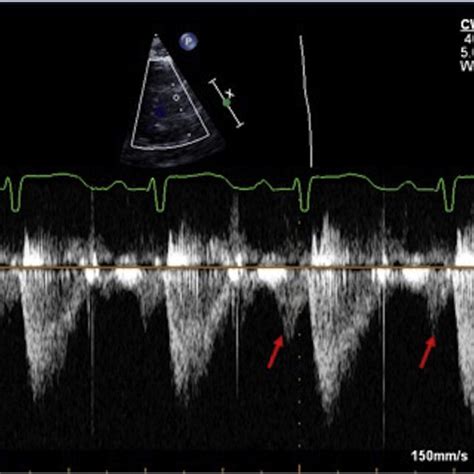 Right End Diastolic Forward Flow By Echocardiography 87 Restrictive