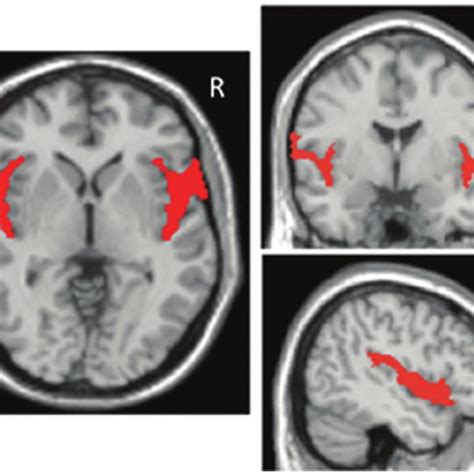 Tracing Of The Region Of The Sylvian Fissure Overlaid On Three