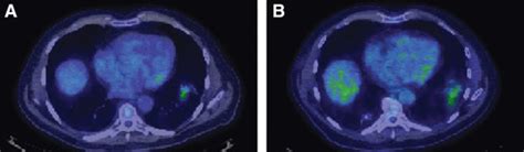 Pseudoprogression After Stereotactic Body Radiotherapy Journal Of