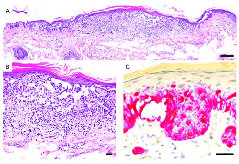 PRAME Immunoreactivity In A Superficial Atypical Melanocytic