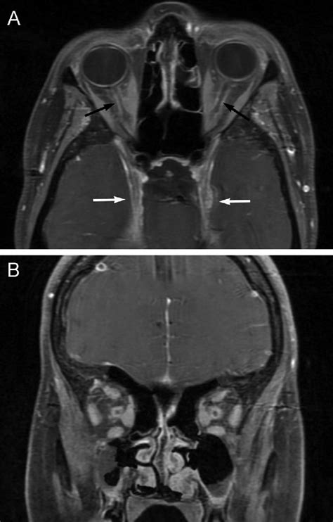 Bilateral Optic Nerve Sheath Meningiomas A T1 Weighted Fatsaturated