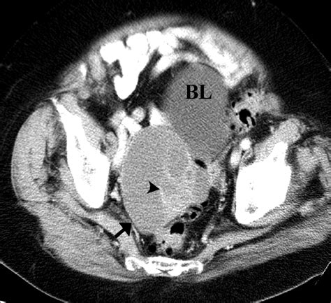 Borderline Tumors Of The Ovary Ct And Mri Features And Tumor Markers